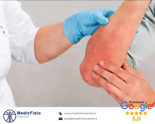 Vai all'articolo: Dermatite: Come Riconoscerla, Rimedi e l'Importanza del Dermatologo