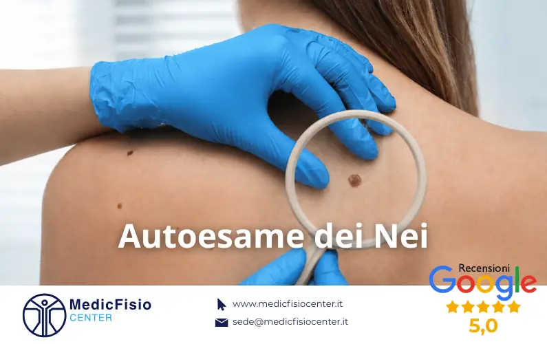 Regola ABCDE dei Nei: Come osservare i propri Nevi