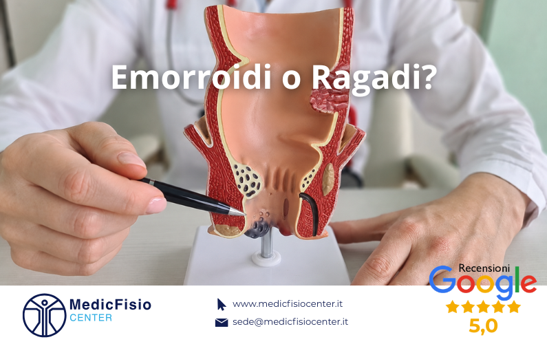 Sanguinamento e bruciore Anale: Emorroidi o Ragadi Anali?