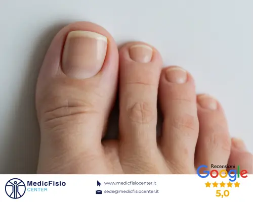 Vai all'articolo: Unghia Incarnita: Attenzione all’estate!